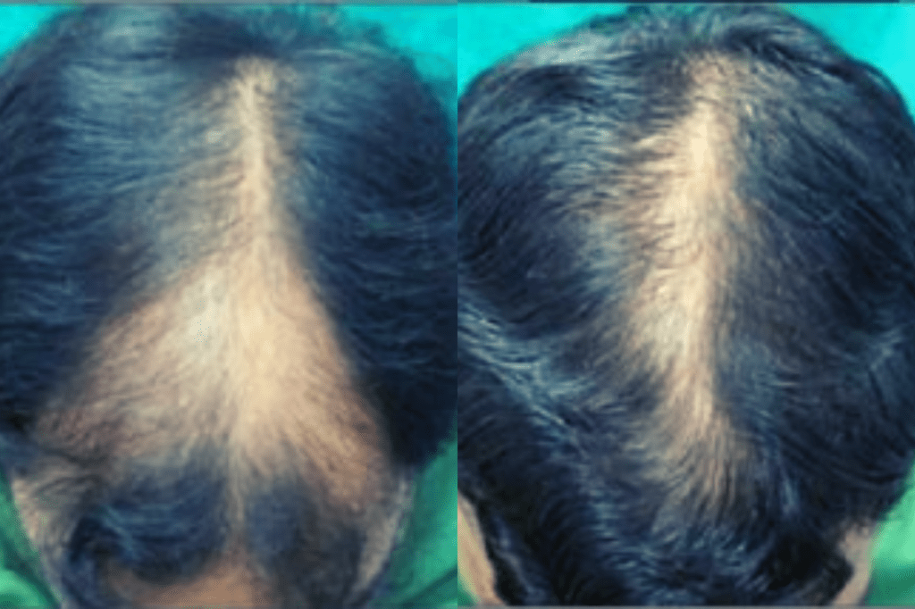 Microneedling For Hair Loss 1