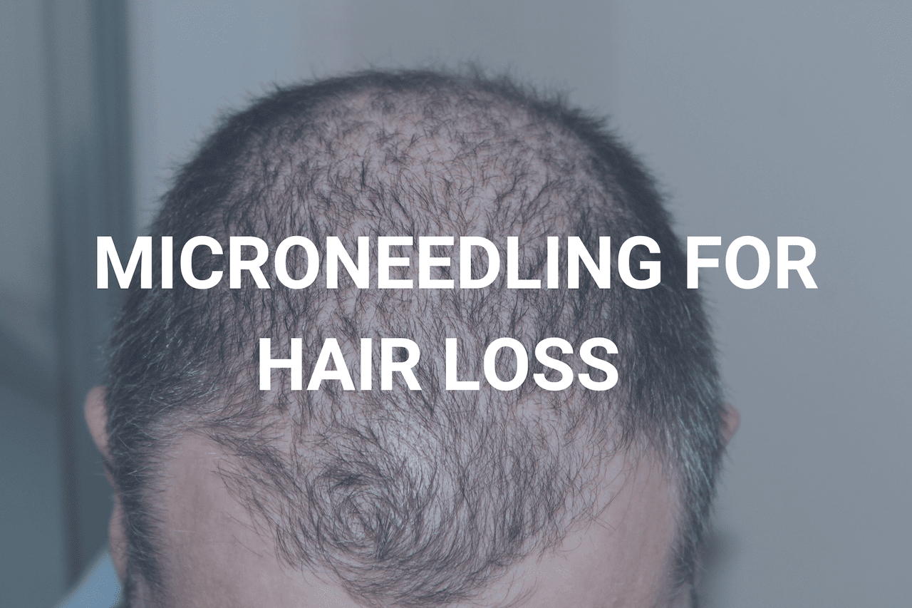 Microneedling For Hair Loss - Pro Needling