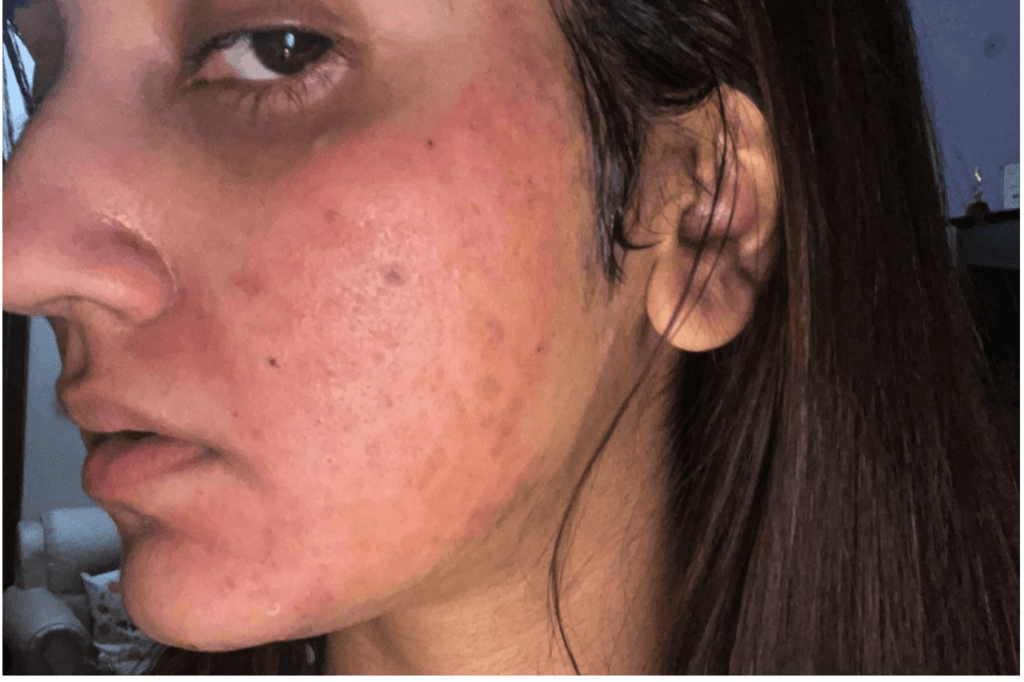 After Microneedling with PRP