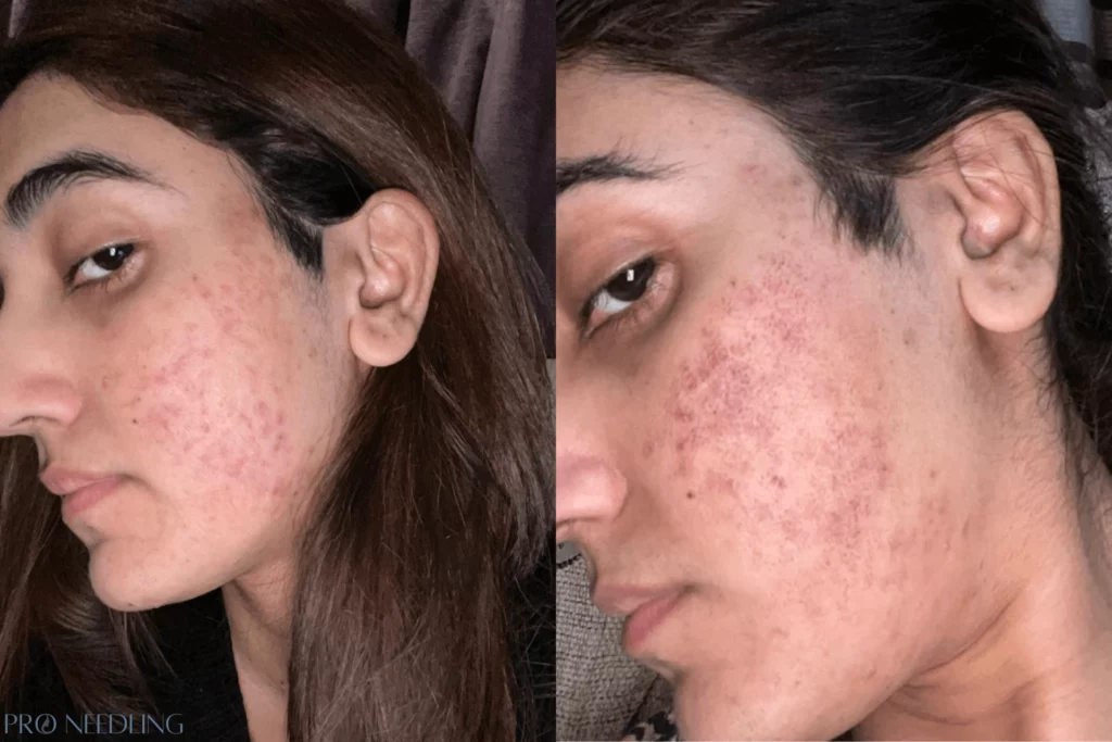 Before and after microneedling with prp treatment