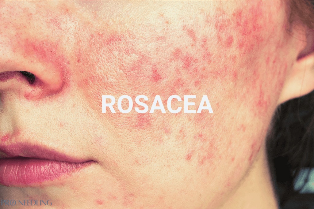 microneedling for rosacea